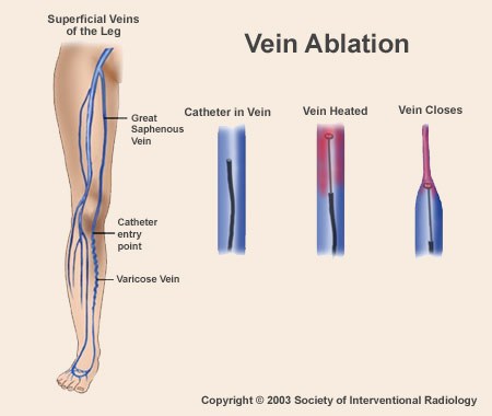 Our Vein Disease Treatments - The Vein Center